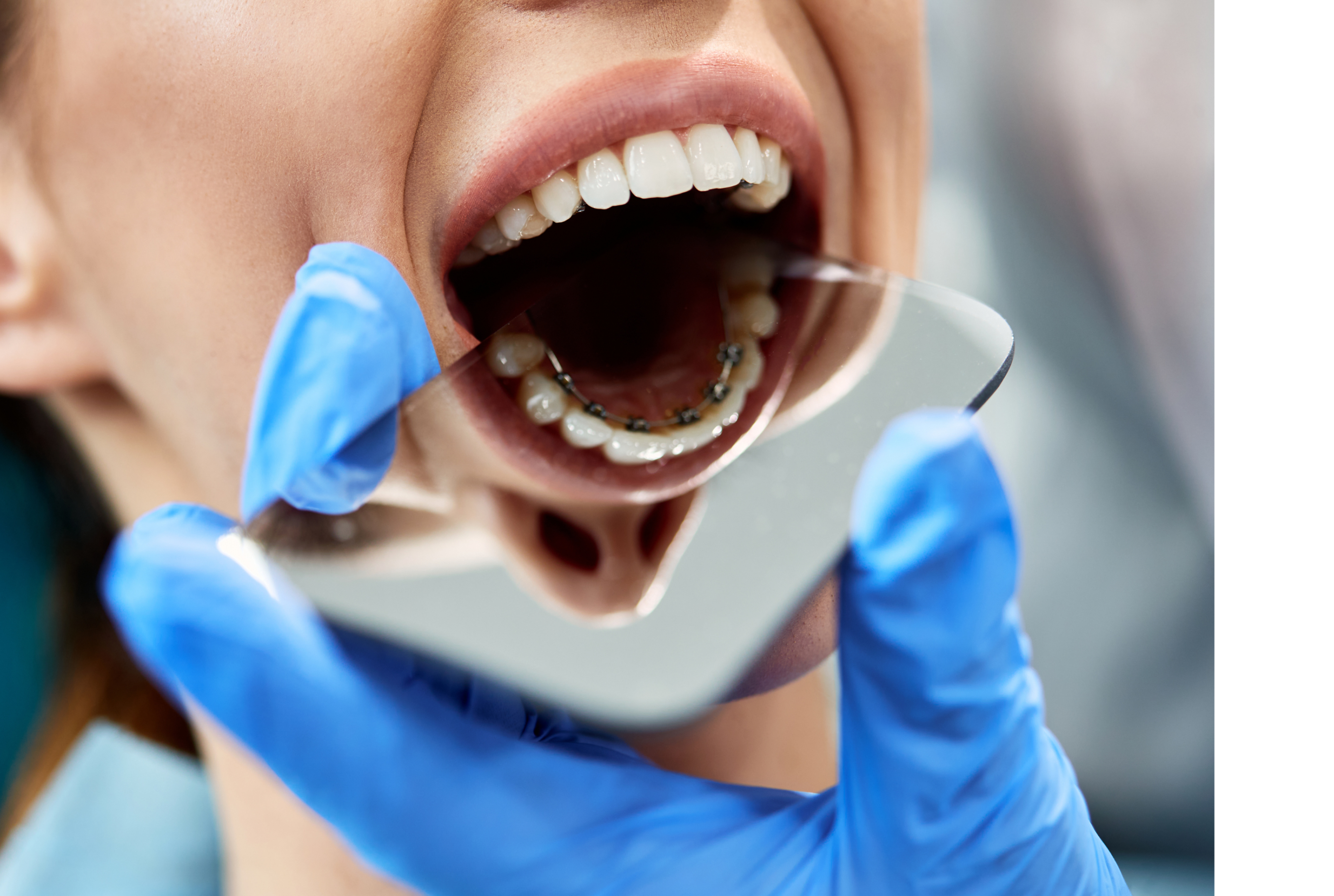 Brackets linguales