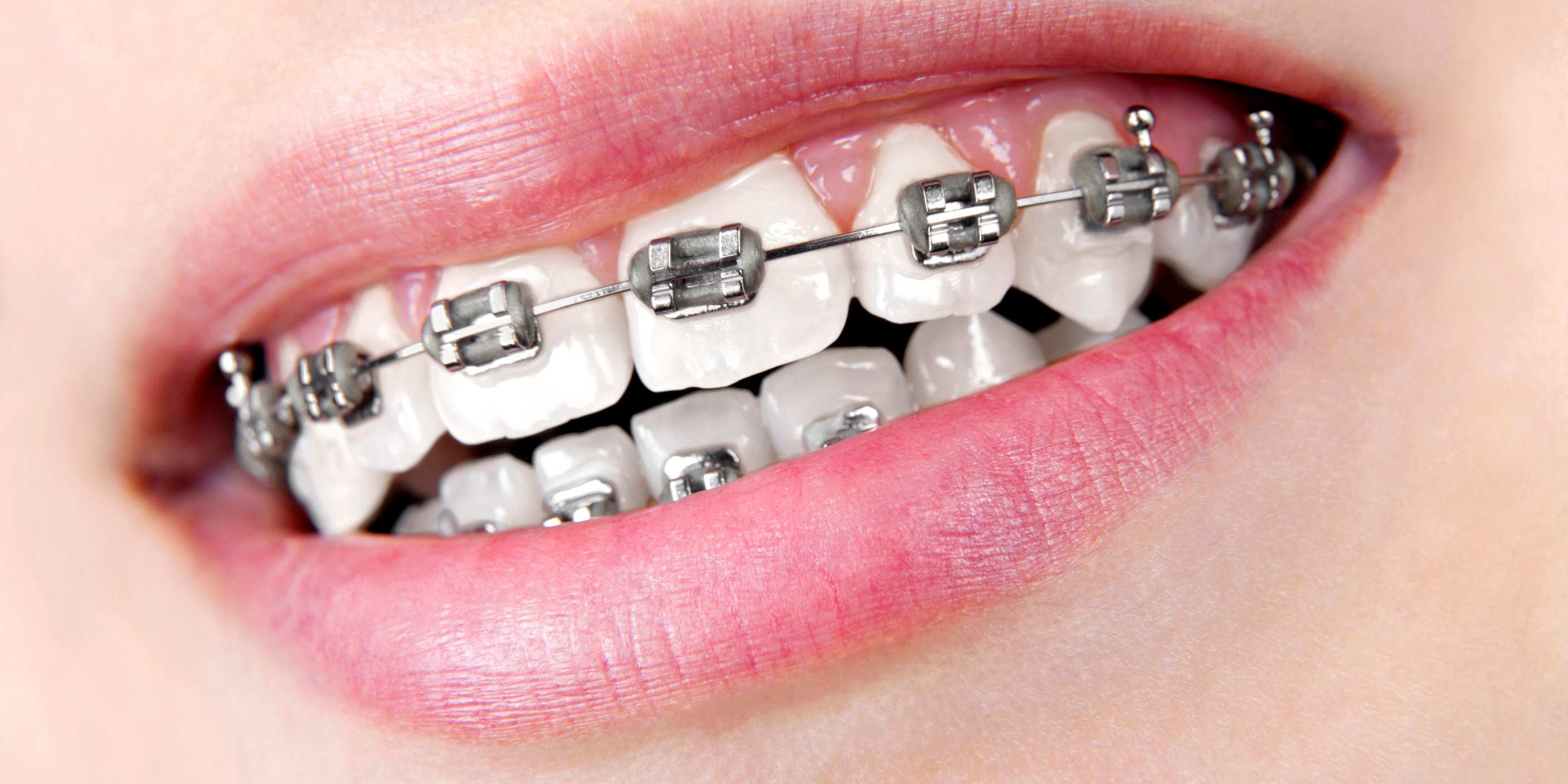 Brackets metálicos con ligadura gris