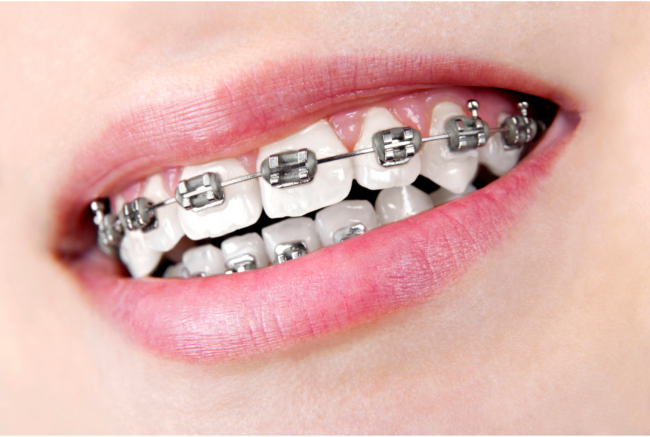 Brackets metálicos con ligadura gris
